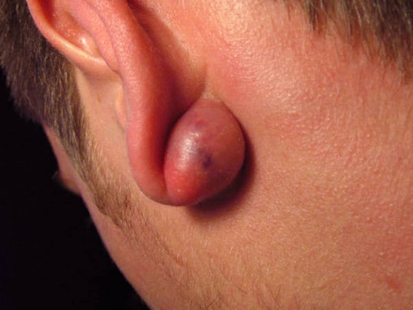 infeksi telinga benjolan